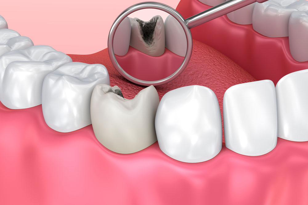 Estrategias Innovadoras y Tech para Evitar Caries