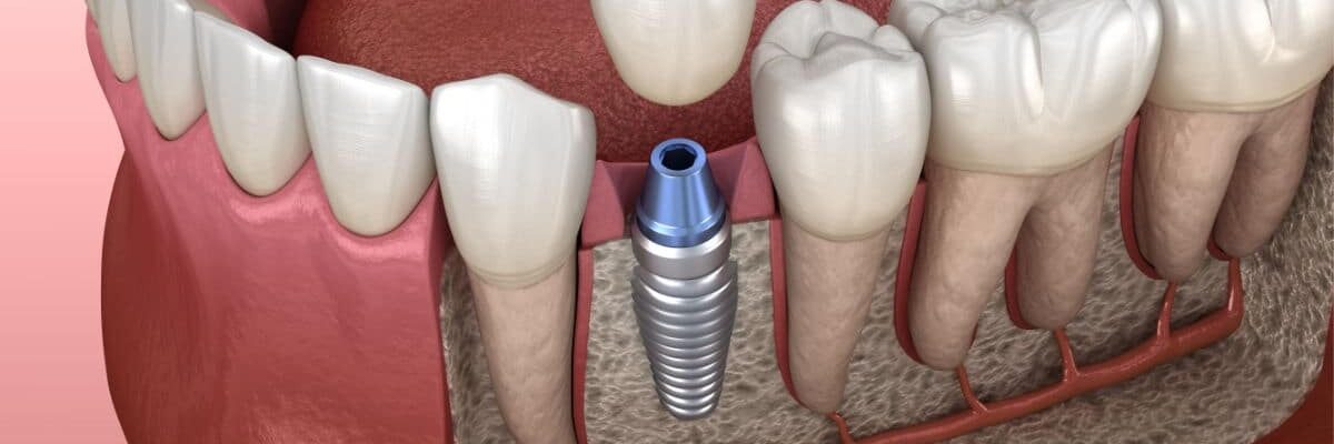 implantología dental