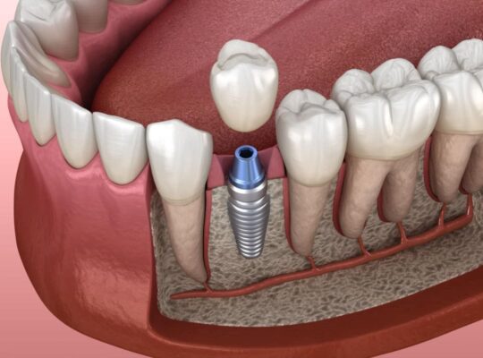 implantología dental