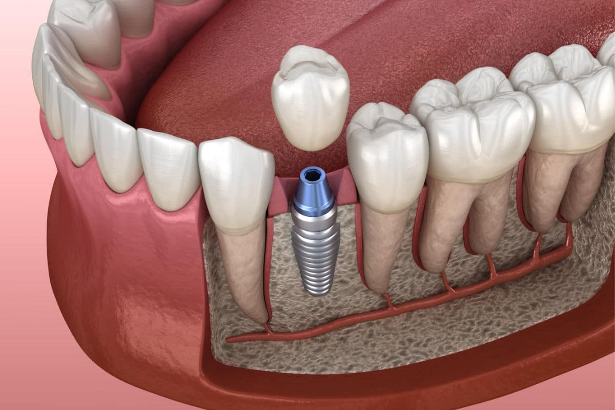 La Nueva Era de la Implantología Dental