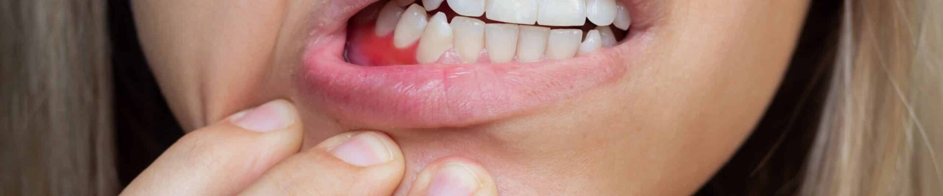 periodontitis